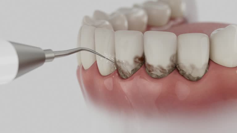 Trusted Wisdom Tooth Removal service in River Hills, WI - Dentist Open Now